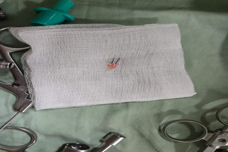 Infant Saved After Critical Surgery at GB Pant Hospital in Agartala